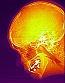 Normal X-ray of Sinuses