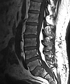 Epidural Lipomatosis,MRI