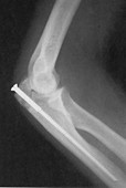 Broken Arm with Metal Pin,X-Ray