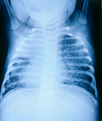 Tuberculosis in 6-Month-Old,X-ray