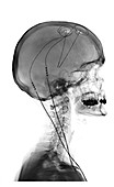 Deep Brain Stimulating Electrodes,X-ray