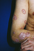 Psoriasis of the Arm