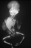 Deformed Fetus,X-ray