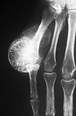 Osteoma on Finger,X-ray