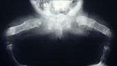 Osteogenesis imperfecta,X-ray