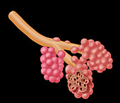 Alveoli Damaged By Emphysema