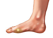 Corns or Calluses of the Foot