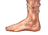 Skin Ulcer from a Varicose Vein