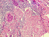 TB lymphadenitis Langhans cell