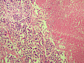 Breast adenocarcinoma with necrosis
