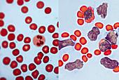 Healthy Leukaemia Blood Comparison