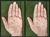 Syphilis rash,stereoscopic image