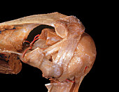 Coracoacromial Ligaments