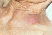 Cold Abscess from Tuberculosis