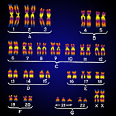 Female Karyotype showing Down's Syndrome