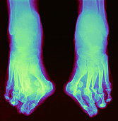 Charcot foot,X-ray