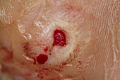 Diabetic Ulcer on Foot