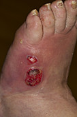 Diabetic Foot Ulcer