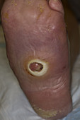 Diabetic Foot Ulcer