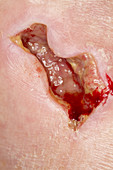 Diabetic Wound On Foot