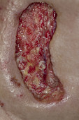 Diabetic Foot Ulcer