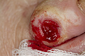 Diabetic Ulcer on Toe