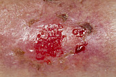 Venous Stasis Ulcer on leg