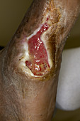 Diabetic Foot Ulcer