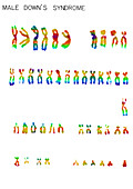 Down's Syndrome karyotype