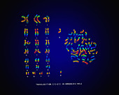 Male Karyotype showing Down's Syndrome