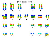 Cri du chat syndrome karyotype