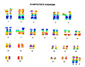 Klinefelter's Syndrome,Karyotype