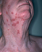 Shingles,Herpes Zoster,Virus