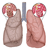 Illustration of Emphysema