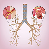 Chronic Obstructive Pulmonary Disease