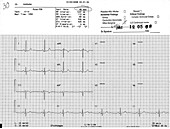Normal EKG with High Blood Pressure