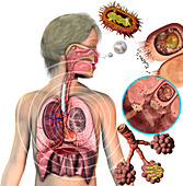 Whooping Cough (Pertussis)