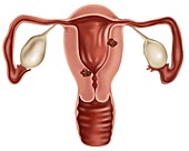 Endometrial Cancer