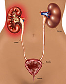 Pyelonephritis (Kidney Infection)