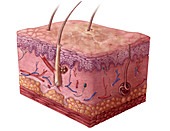 Actinic Keratosis