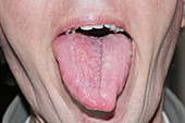 Allergic Reaction of the Tongue