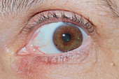 Contact Dermatitis on Eyelid