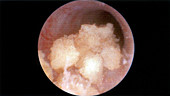 Kidney Stones in Ureter