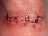 Wound Healing (1 of 4)