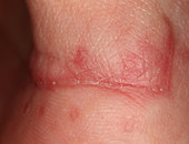 Wound Healing (4 of 4)