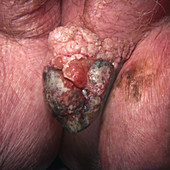 Squamous Cell Carcinoma on Vulva