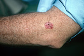 Basal Cell Carcinoma on Arm
