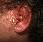 Herpes Zoster on Ear