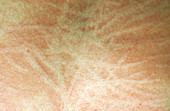 Dermatographic Urticaria
