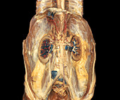 Dissected Kidneys